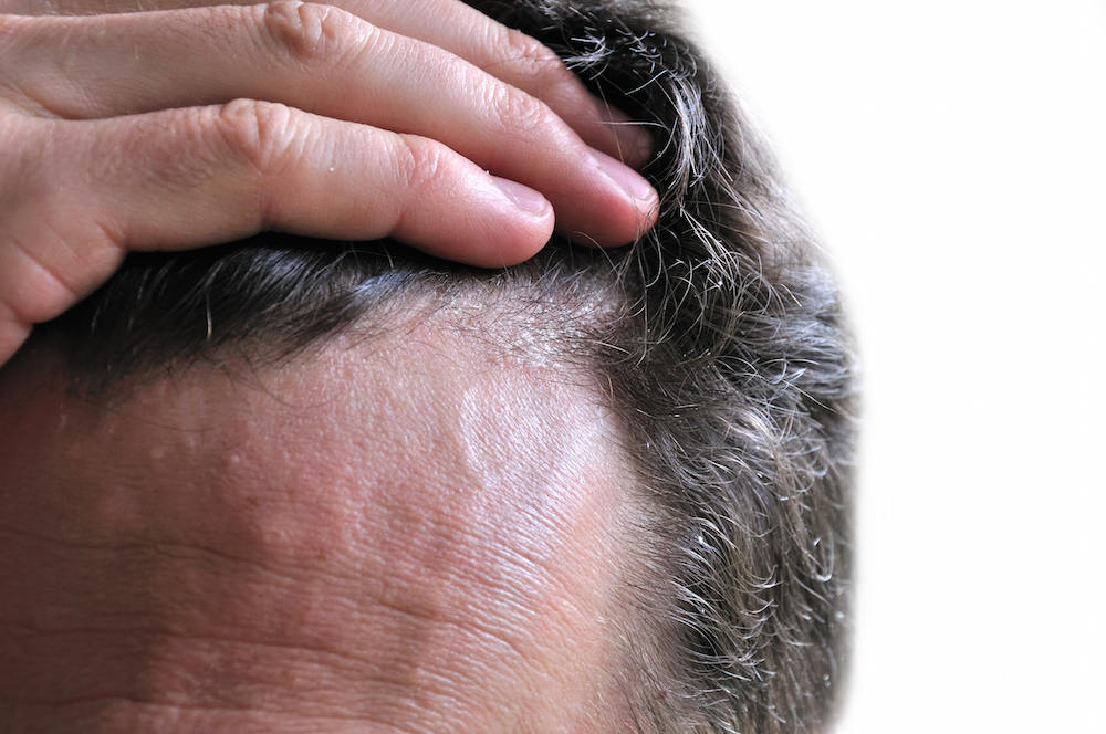 لیزرتراپی مو برای درمان ریزش مو