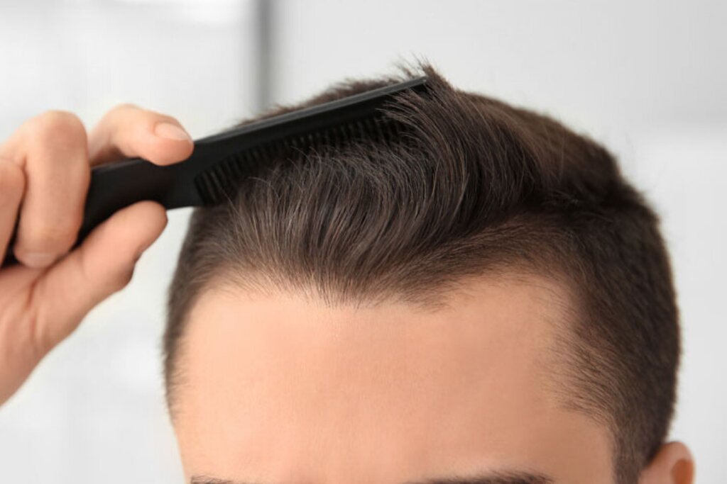 آیا کاشت مو در رامسر موثر است