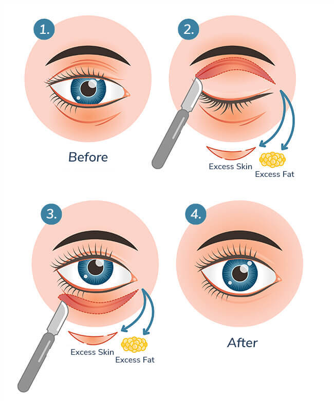 فرایند جراحی پلک 