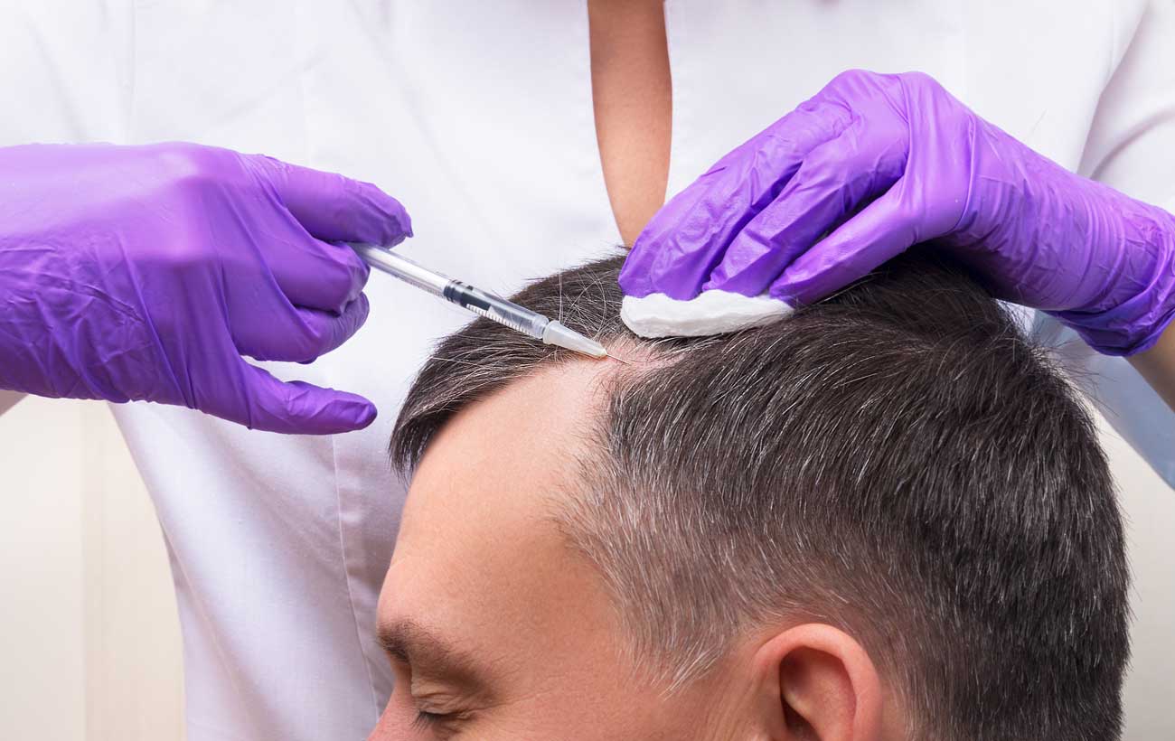 درمان های ریزش مو: مزوتراپی