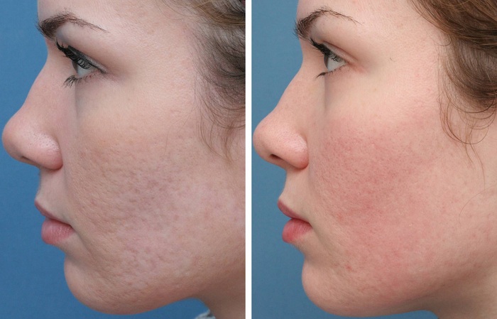 تصویر قبل و بعد پوست صورت مراجعه کننده در لیزر co2