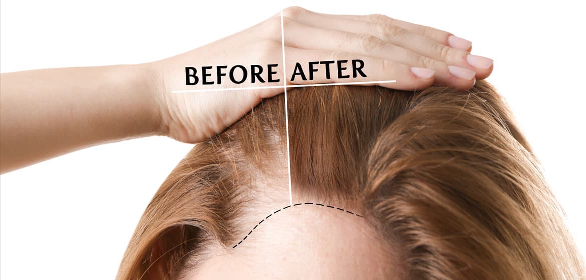 درمان قطعی ریزش مو زنان