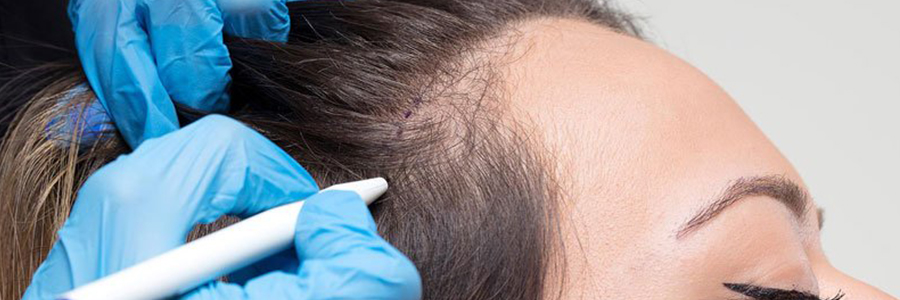 فرآیند کاشت مو در زنان
